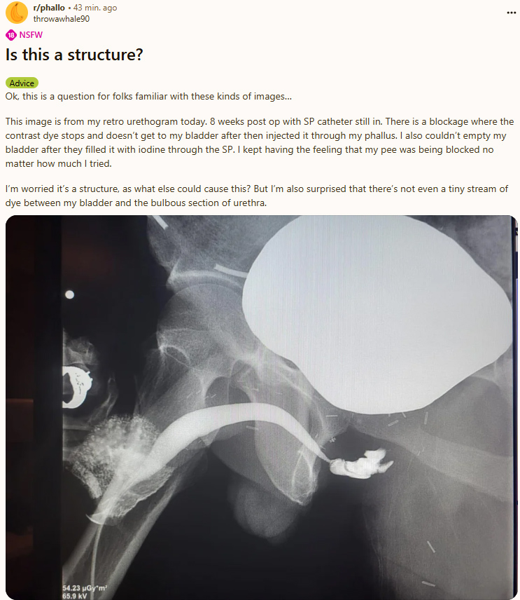 Bladder_stricture.jpg