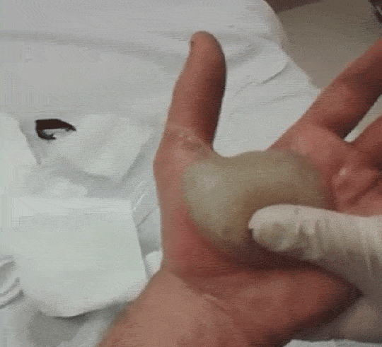 blister.gif