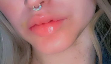 bruise..PNG