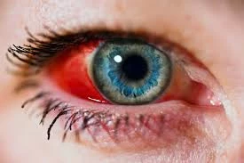 burst blood vessel.webp