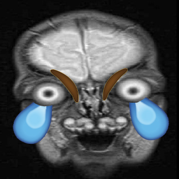 Crying-while-laughing-front-facing-MRI.jpg