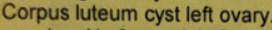 cyst.png