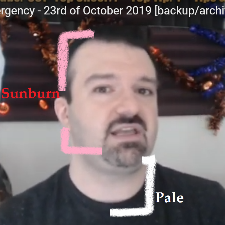 dspSunburn.png