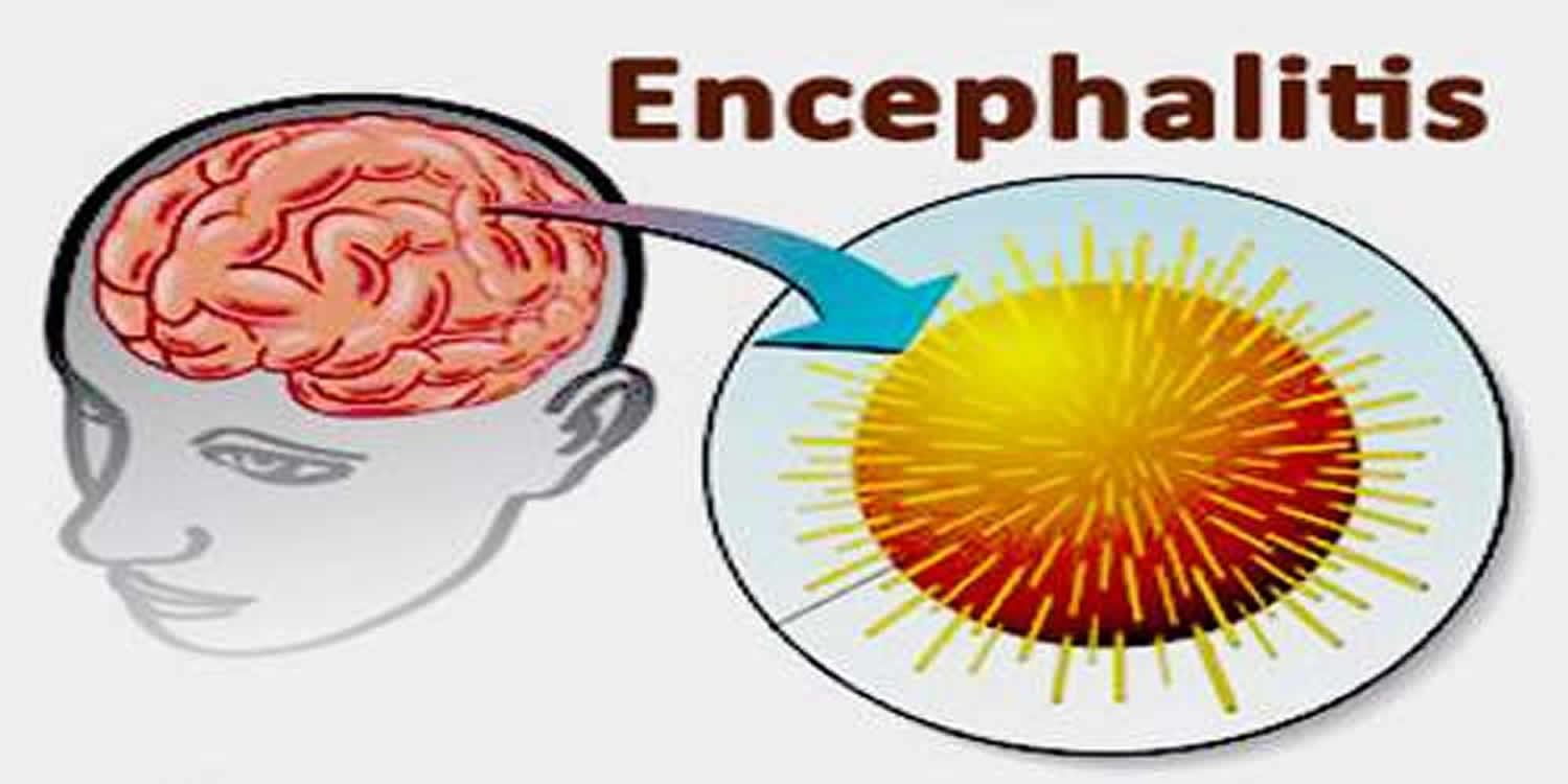encephalitis.jpg