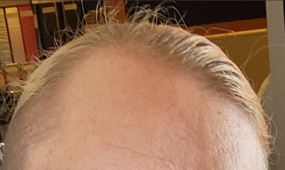 forehead.png