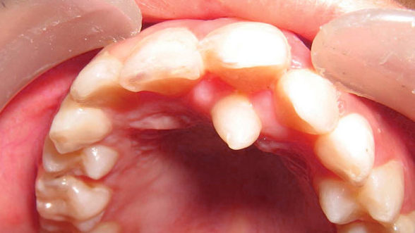hyperdontia.jpg