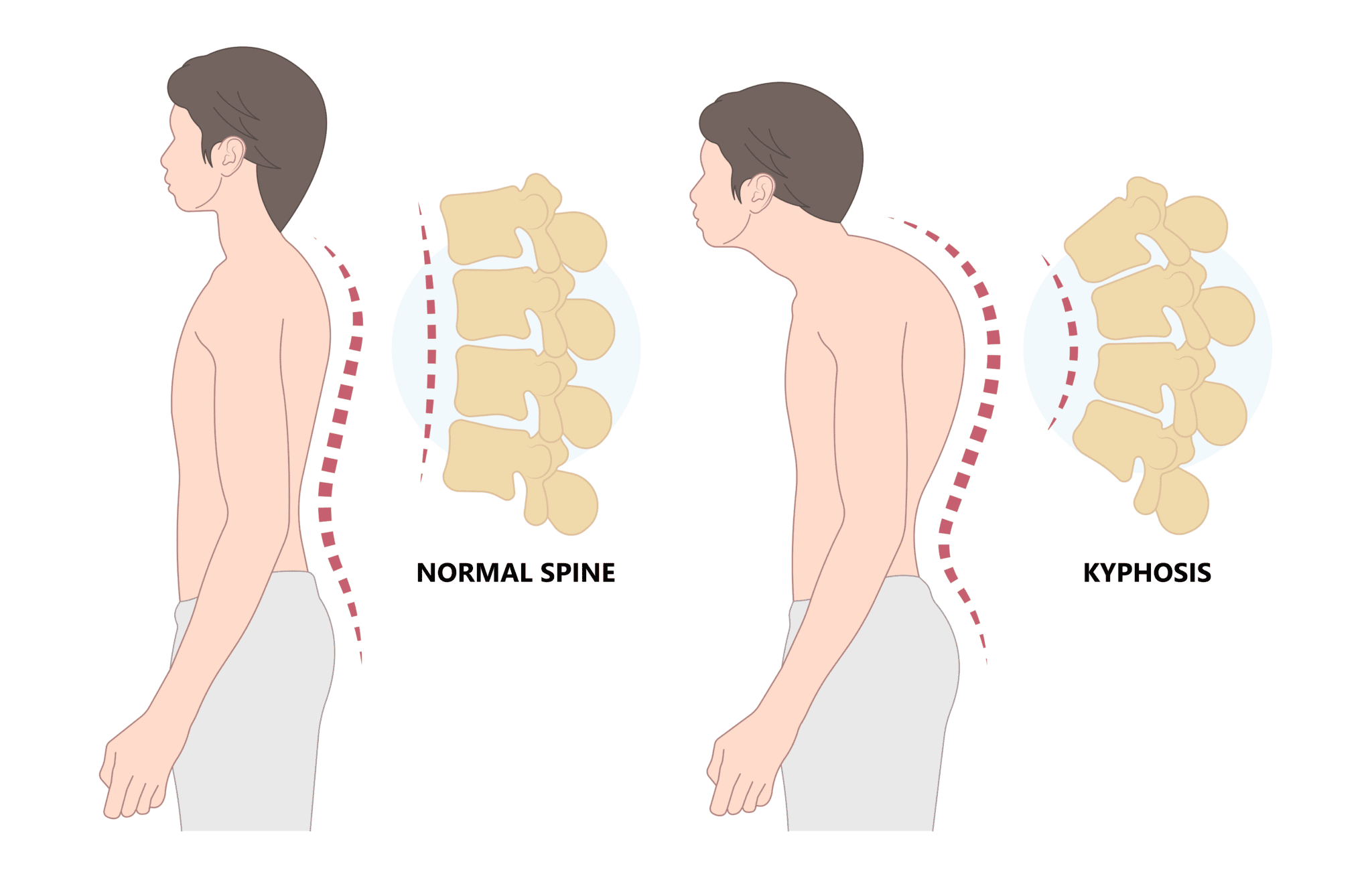 kyphosis.png