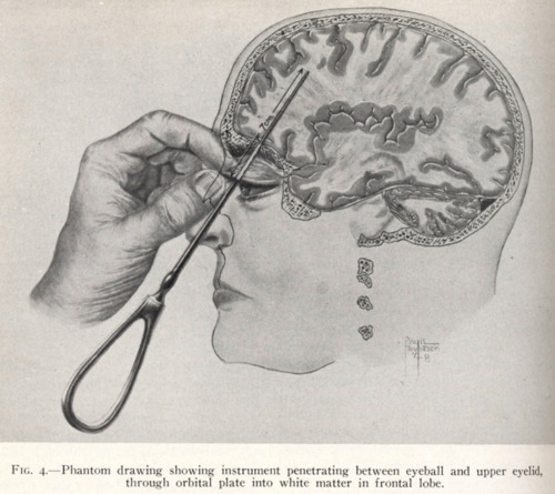 lobotomy.jpg