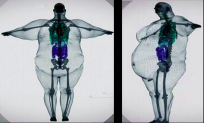 Obese Skeleton.png