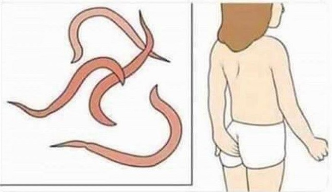 pinworm.jpg