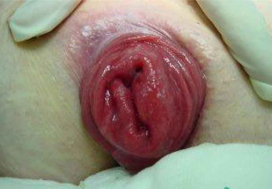 prolapse.jpg