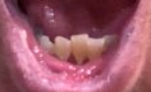 RottenTeeth.png