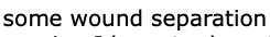 some wound separation.png