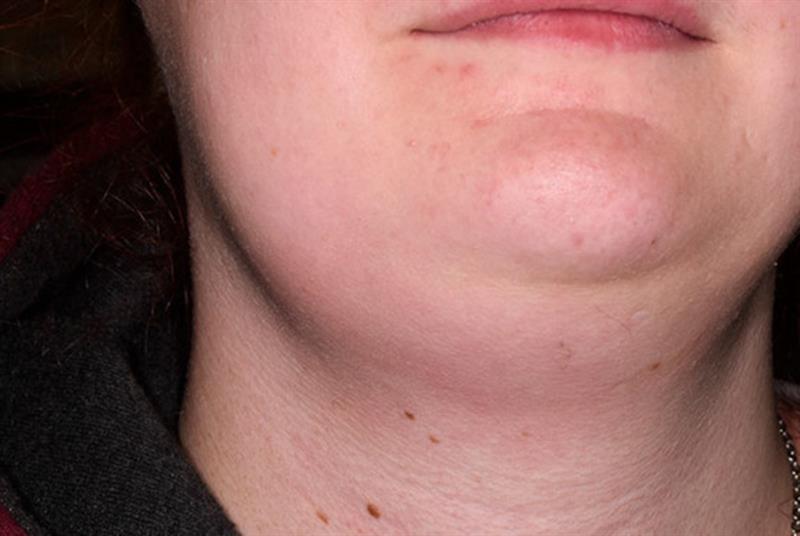 swollen lymph node.jpeg